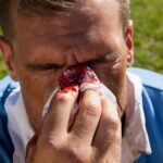 The right way to treat a stubborn nosebleed